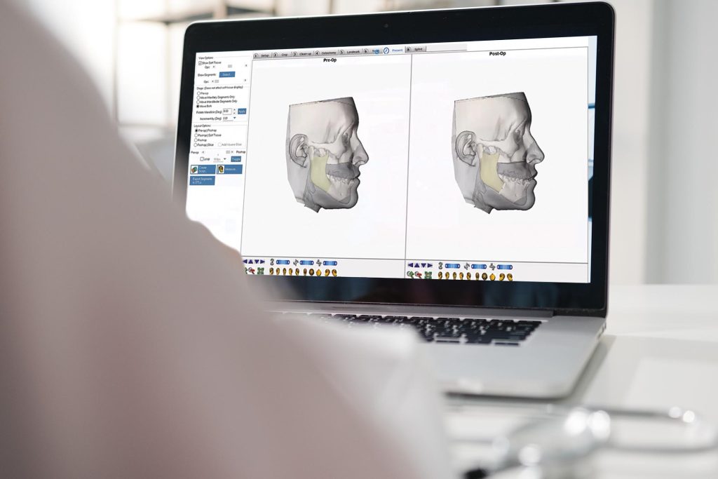 Importância do planejamento virtual para a cirurgia ortognática